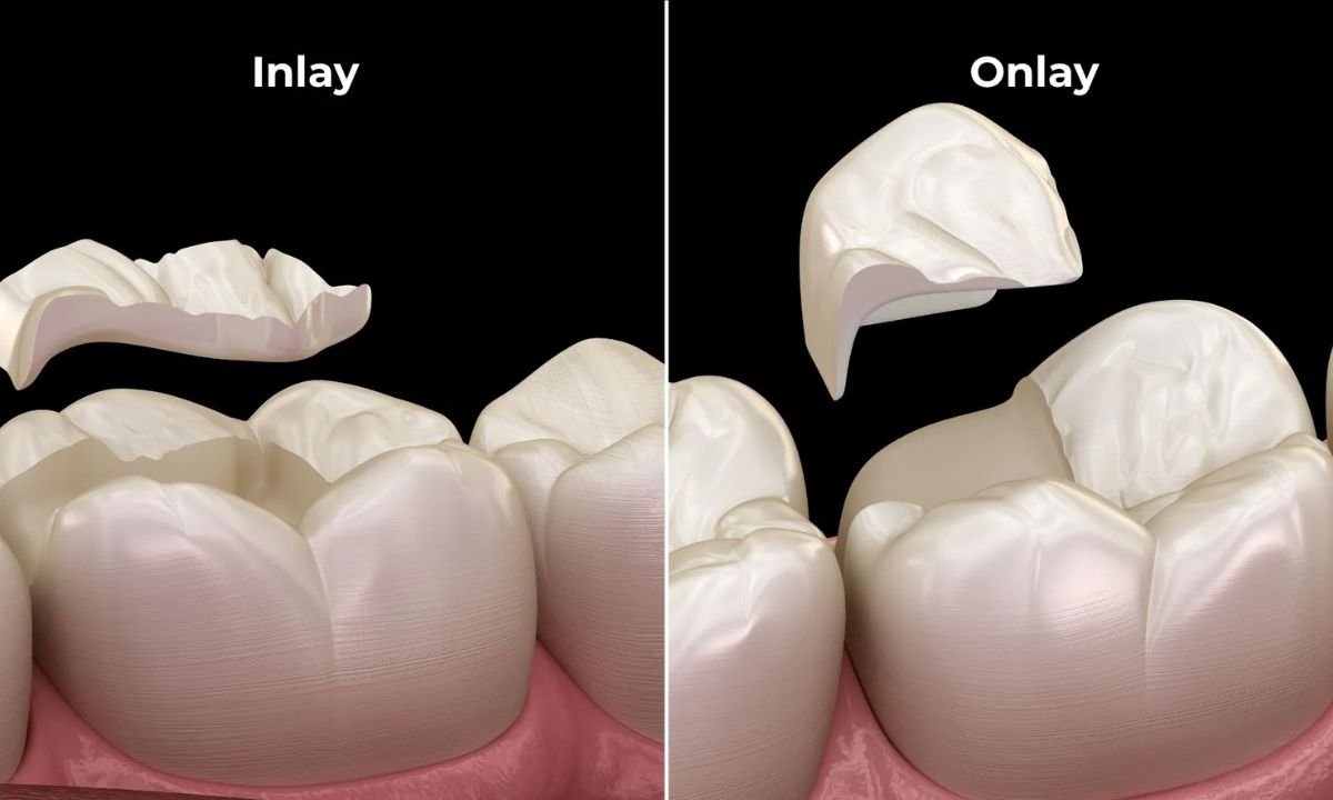 Inlays and Onlays: What They Are and How They Differ